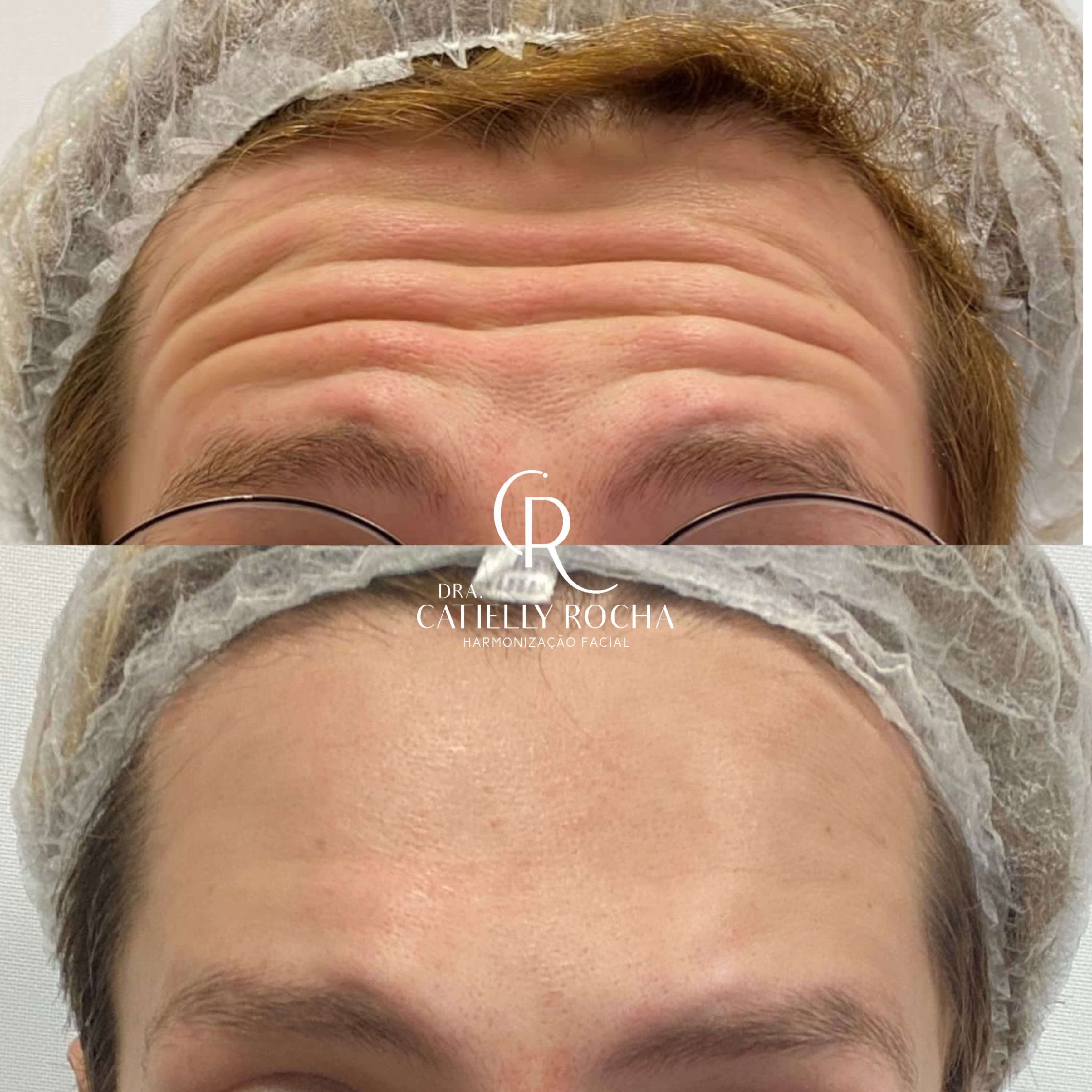 Resultado antes e depois de aplicação de toxina botulínica na testa